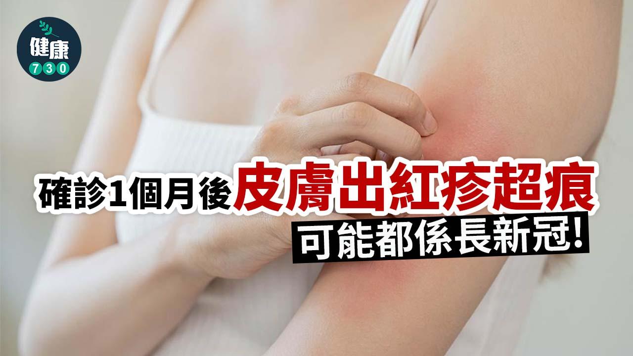新冠後的癢疹與一般過敏疹外觀類似,以凸或平的紅疹為主,並不會特別嚴重,可是皮疹和搔癢症狀會持續數週甚至更久,因此治療上更需要持久恆心。