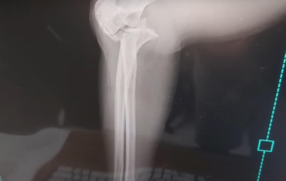 X光機發現她的手臂骨折,隨即要接受手術,以鋼板和骨釘螺絲固定骨頭。(YouTube)