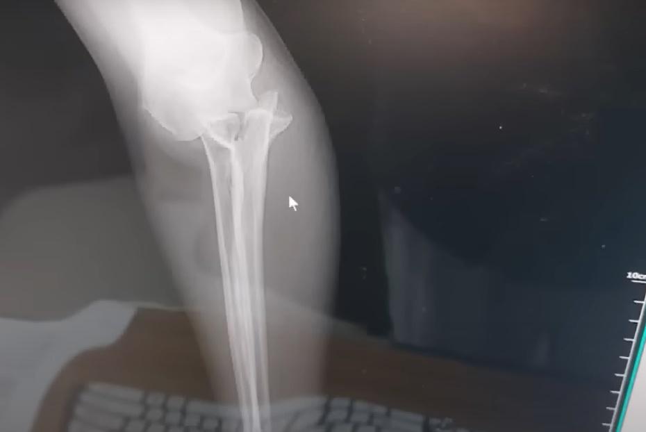 X光機發現她的手臂骨折,隨即要接受手術,以鋼板和骨釘螺絲固定骨頭。(YouTube)