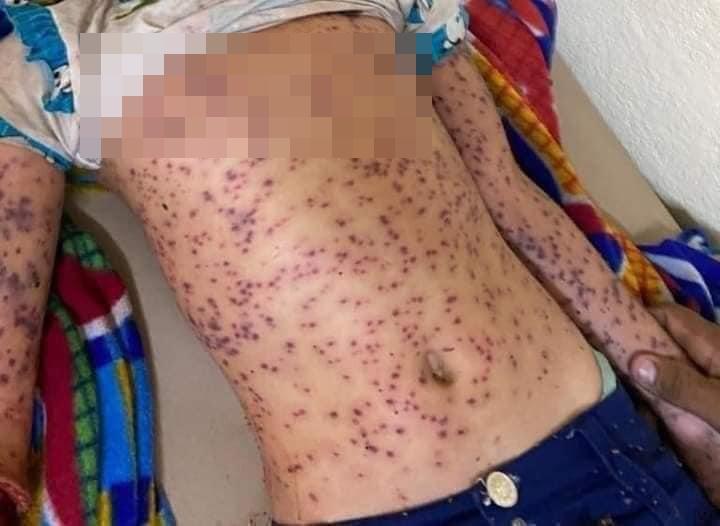 據當地傳媒相片可見,死傷者幾乎全身佈滿密密麻麻被蜂螫傷的紅色點。(Twitter)