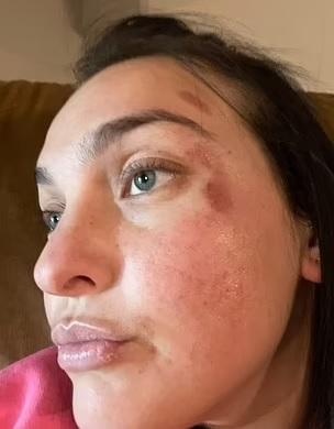 艾莉莎展示傷勢。(互聯網)