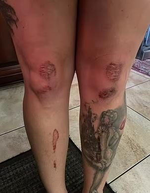 艾莉莎展示傷勢。(互聯網)