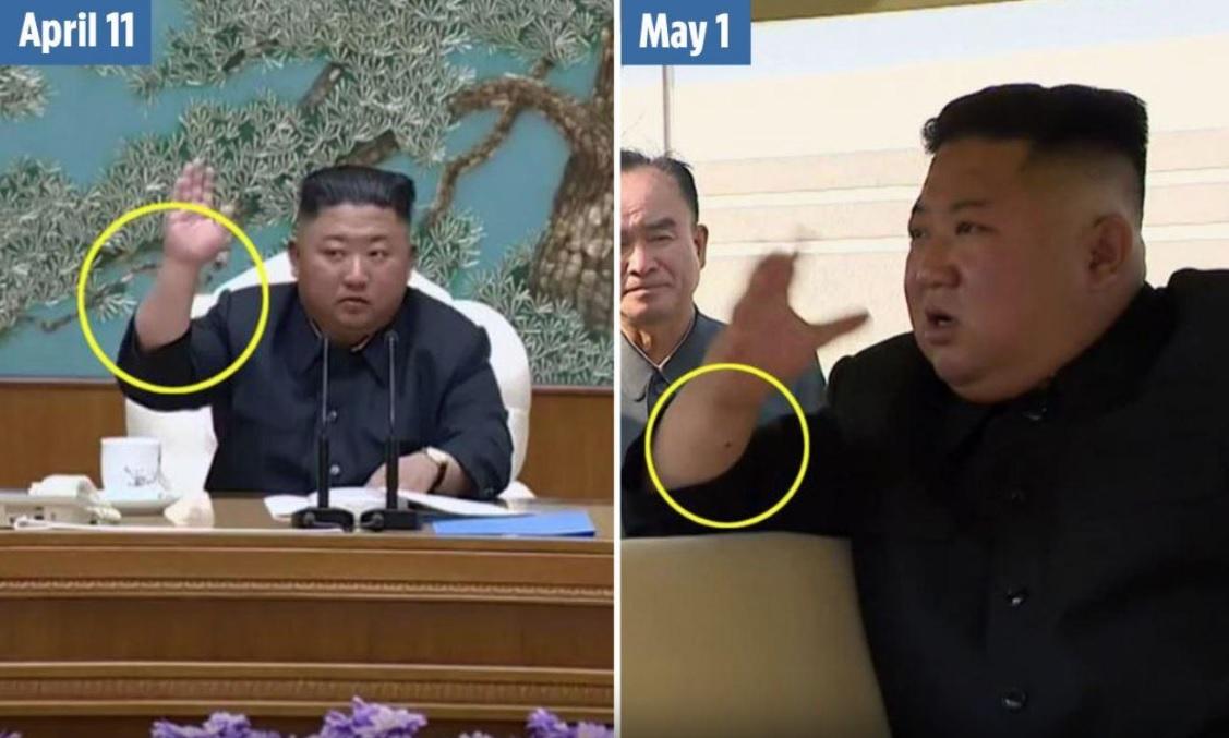 金正恩2020年神隱3周後於4月現身,手腕有疑似動脈導管穿刺留下的針孔疤痕。(資料圖片)