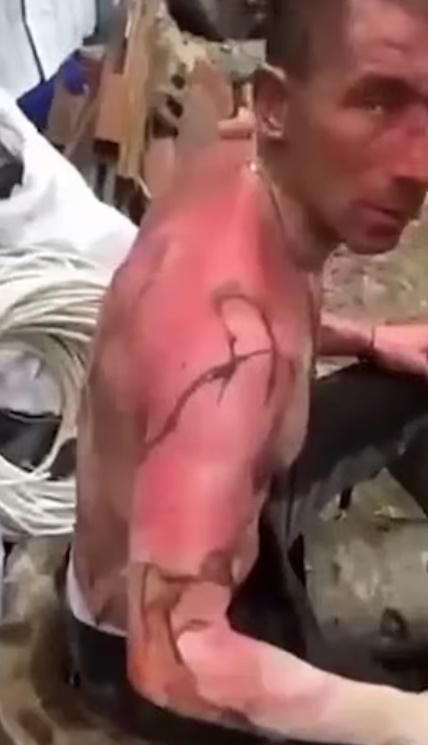 男子全身約有60%以上面積燒傷,仍在加護病房留醫。(Twitter)