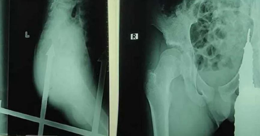 X光片顯示,鐵刺插入男童臀部後,距離肛門只有少少距離。(網上圖片)