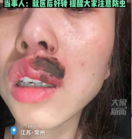 江蘇女半夜被蜈蚣「錫」醒,咀唇麻痺變潤腸。(微博)