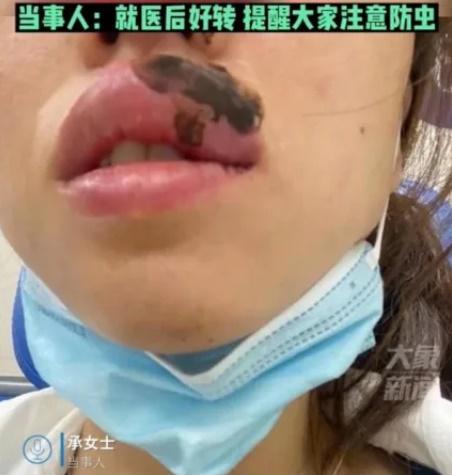 江蘇女半夜被蜈蚣「錫」醒,咀唇麻痺變潤腸。(微博)