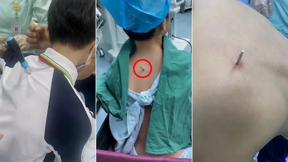 男童被同學用螺絲從背部刺入。(翻攝自微博)