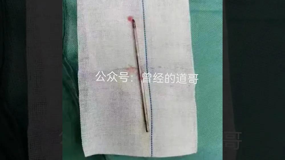 男童被同學從背部刺入的螺絲。(翻攝自微博)