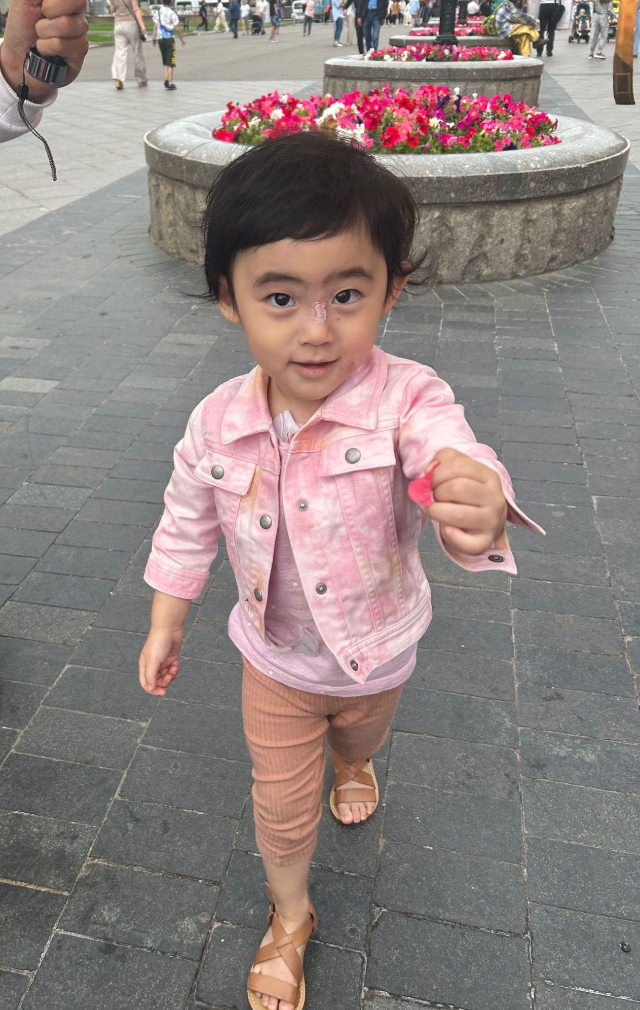 貝貝意外被滾水燙傷鼻樑。