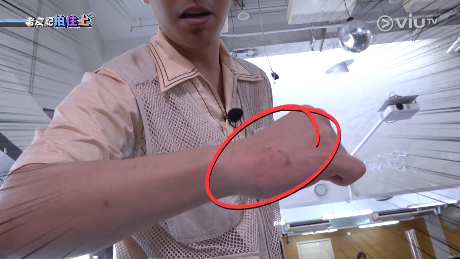 Edan被咬後向鏡頭展示傷勢,。