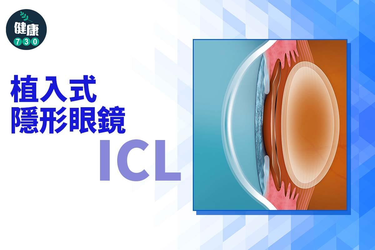 植入式隱形眼鏡