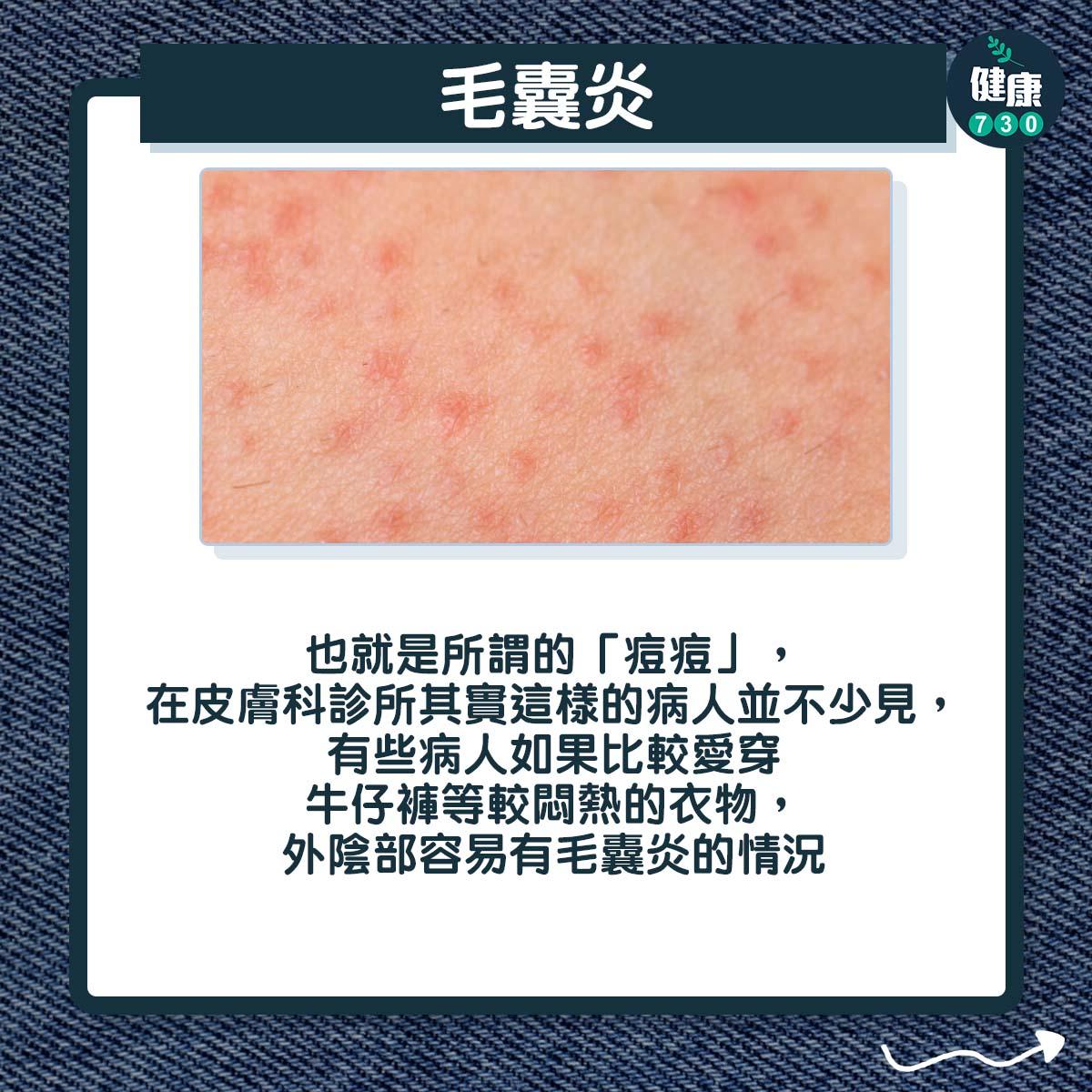 穿牛仔褲易有3皮膚問題|毛囊炎