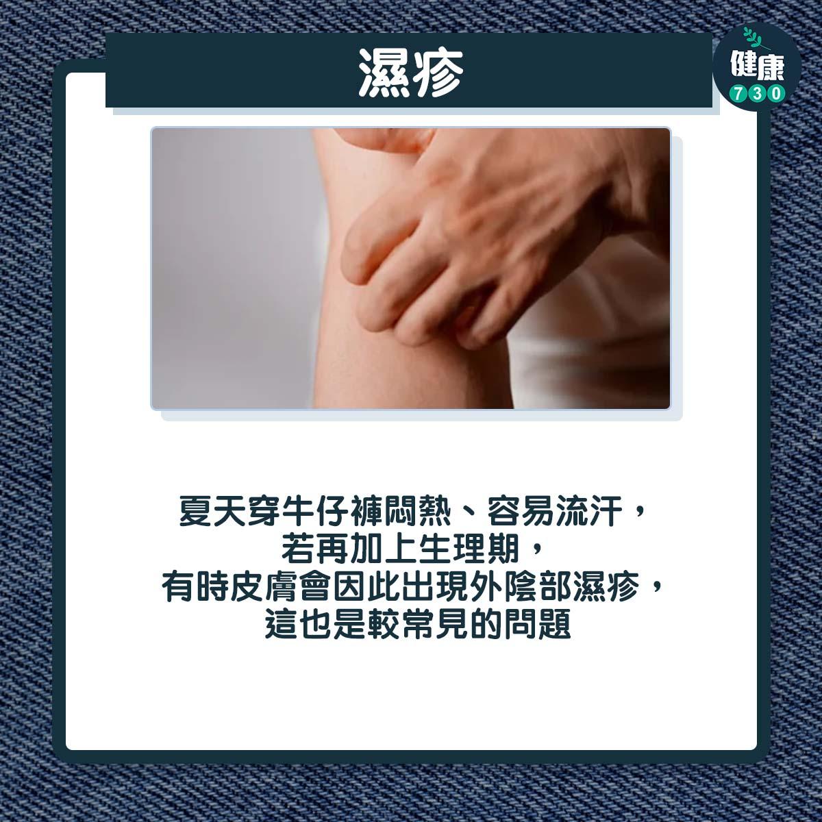 穿牛仔褲易有3皮膚問題|濕疹