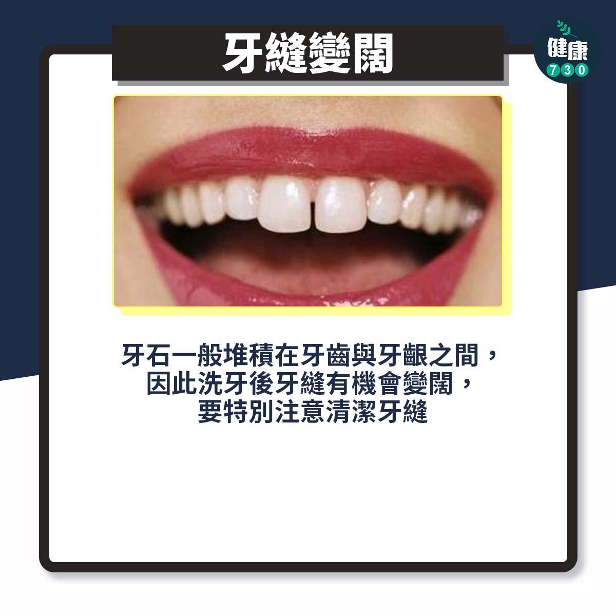 洗牙問題|牙縫變闊