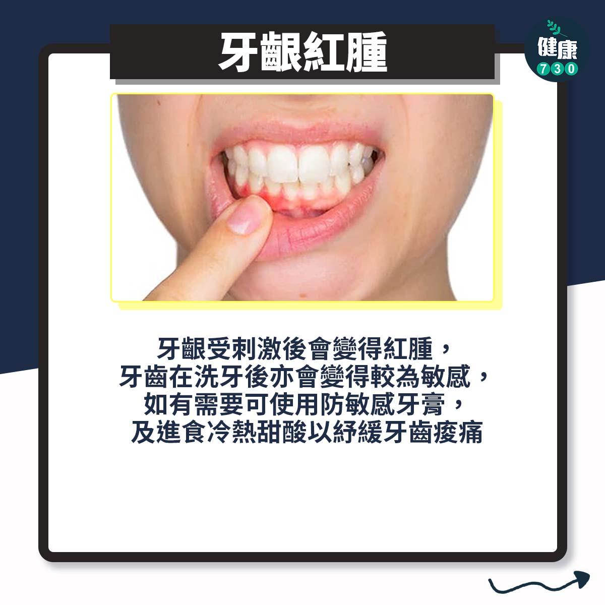 洗牙問題|牙齦紅腫