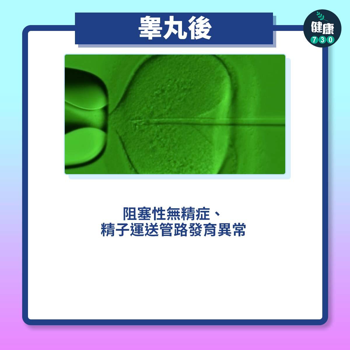 睾丸後:阻塞性無精症、精子運送管路發育異常