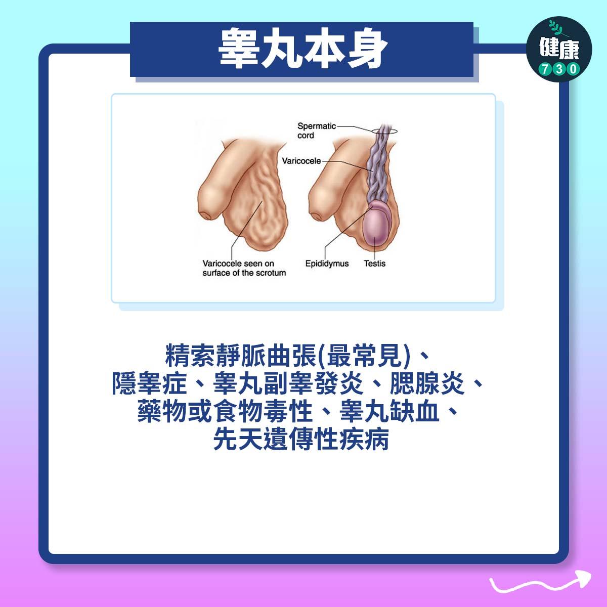 睾丸本身:精索靜脈曲張(最常見)、隱睾症、睾丸副睾發炎、腮腺炎、藥物或食物毒性、睾丸缺血、先天遺傳性疾病