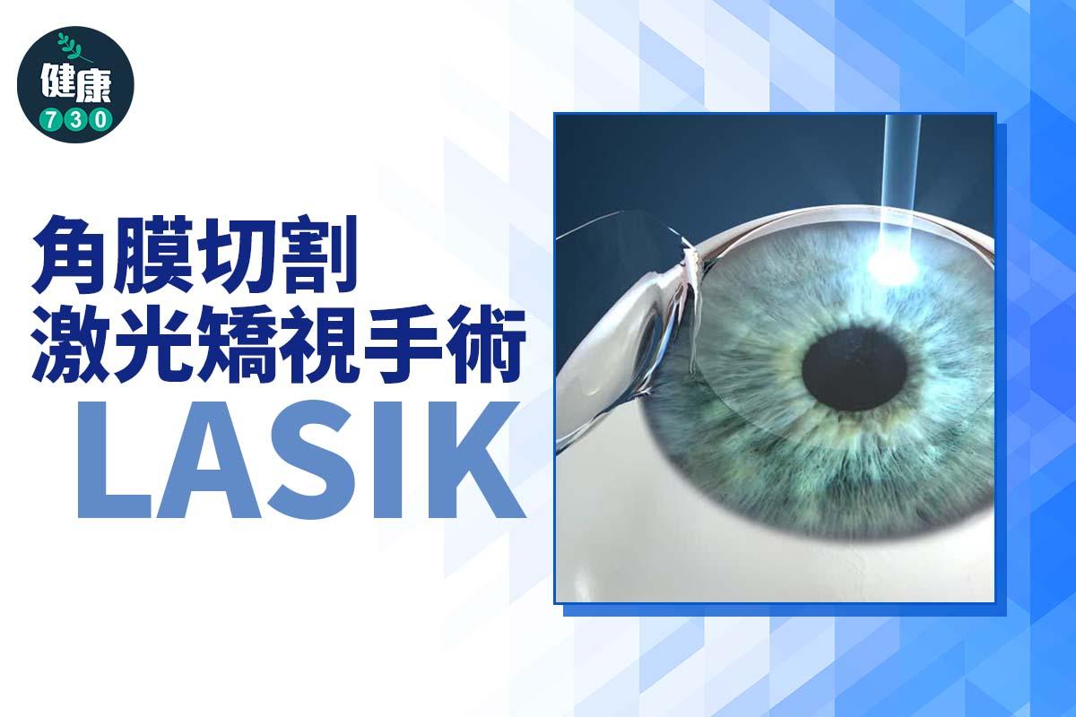 角膜切割激光矯視手術