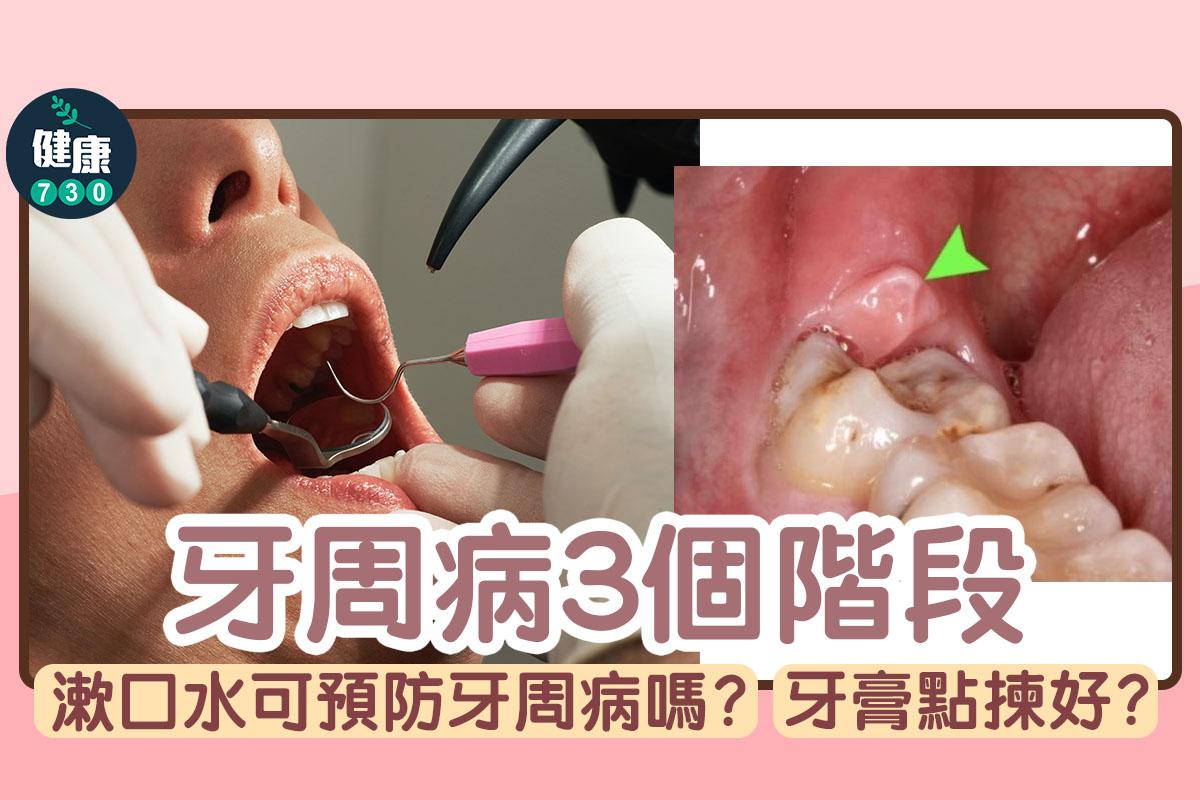 牙周病3個階段,牙膏點揀好?(am730製圖)