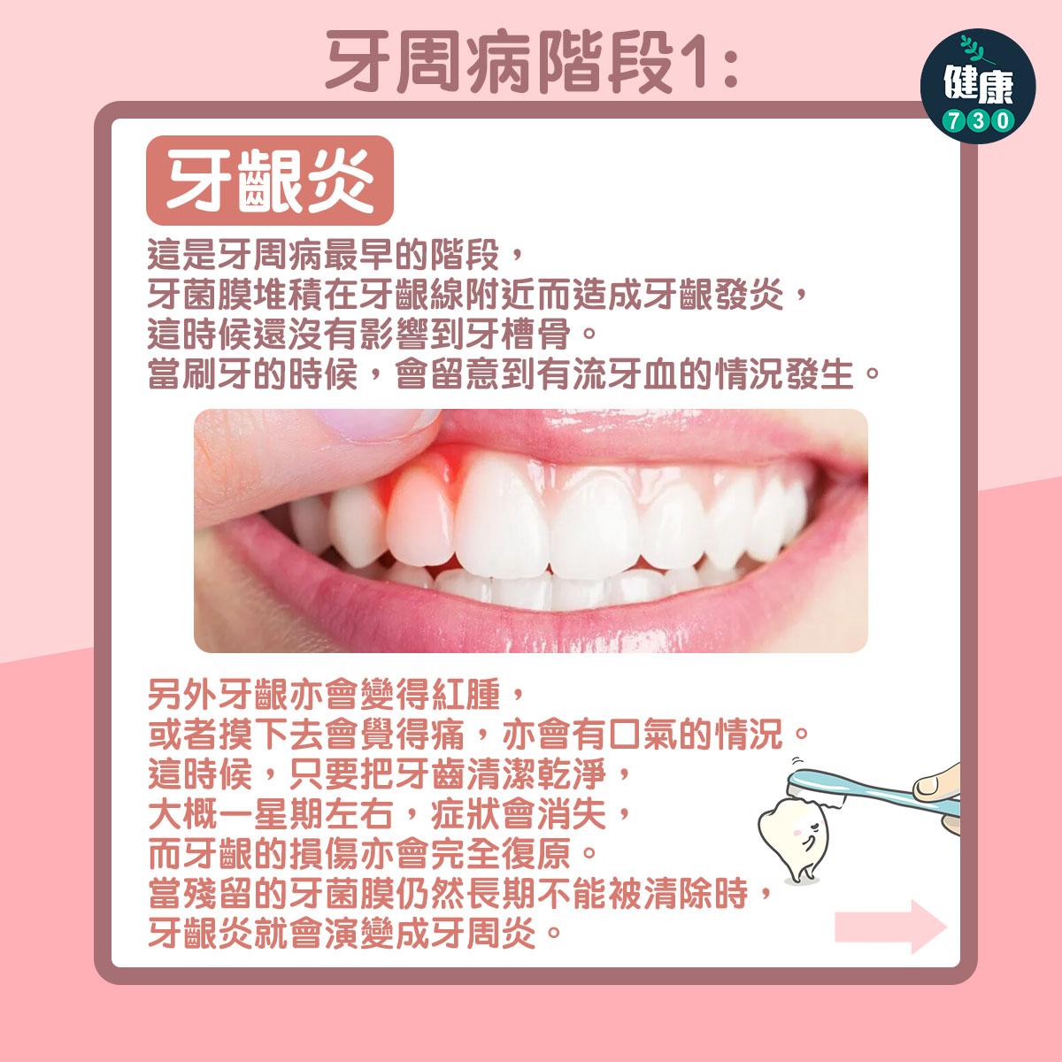 牙周病3個階段,牙膏點揀好?(am730製圖)