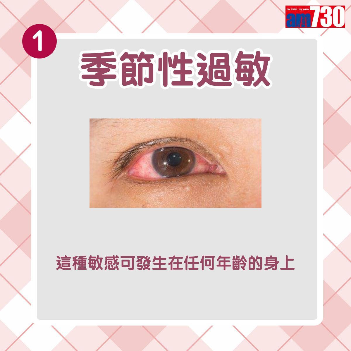 眼晴敏感分3種(am730製圖)