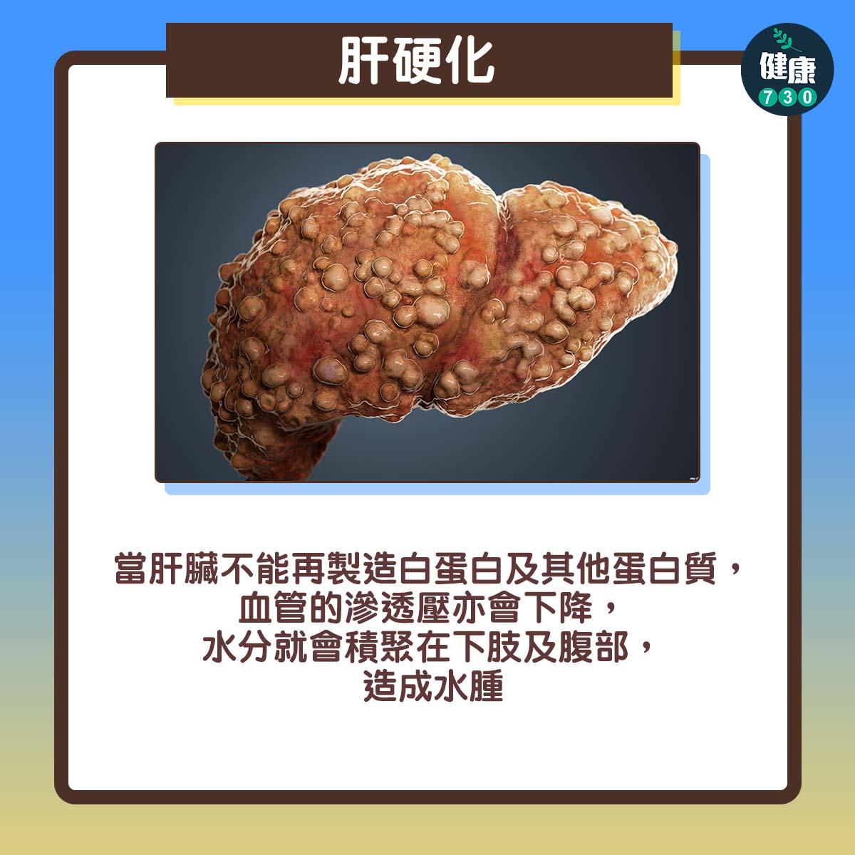 水腫|自我測試(am730製圖)