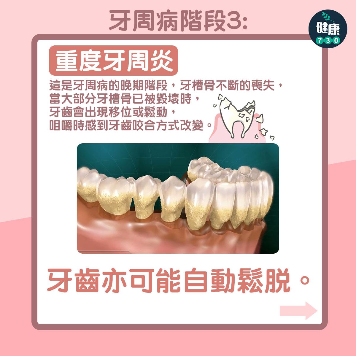 牙周病3個階段,牙膏點揀好?(am730製圖)