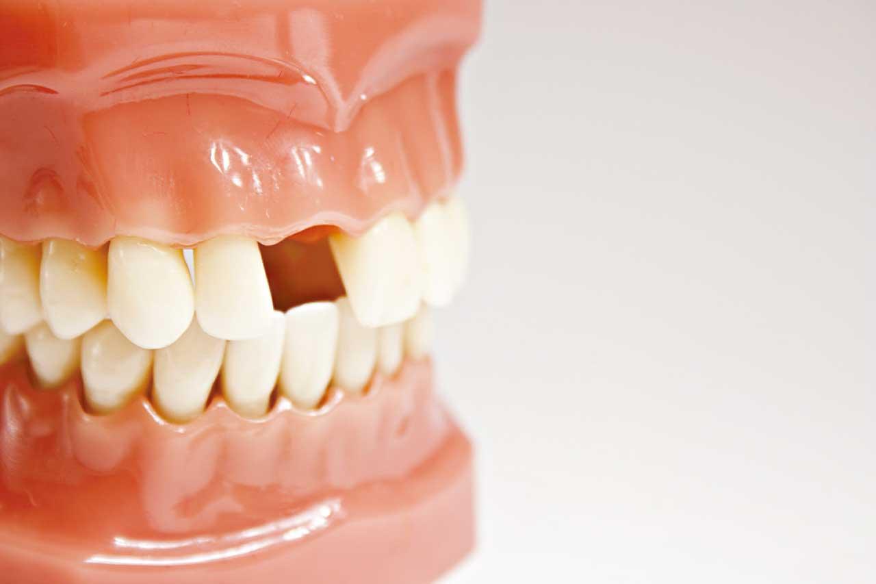 日研究:長者牙少或嚴重牙周病 可加速腦退化