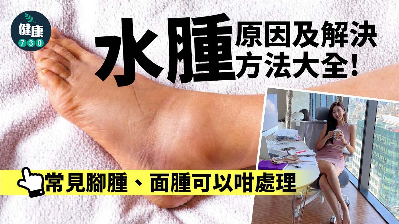 水腫原因及解決方法大全!為什麼會水腫?常見腳腫、面腫可以咁處理