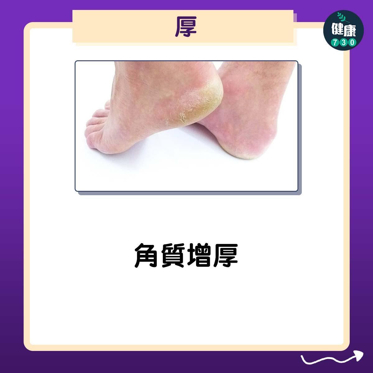 香港腳症狀4大型態(am730)