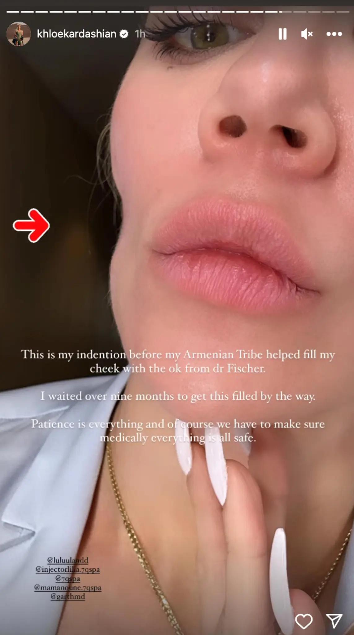 Khloé 分享自己臉頰上的術後痕跡。(圖/翻攝自IG@khloekardashian)