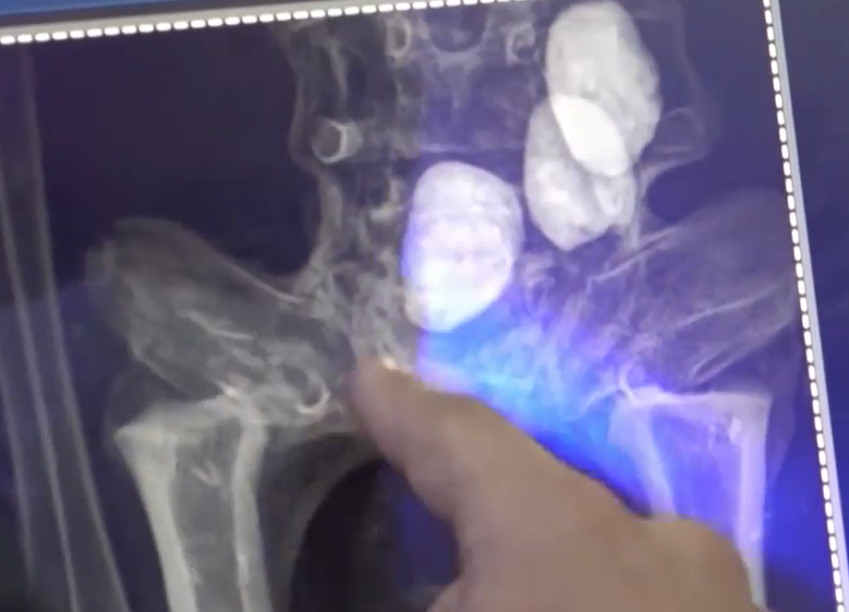 外星人遺骸|X光及電腦掃瞄結果指「外星人遺骸」未經人為接駁組裝。(互聯網)