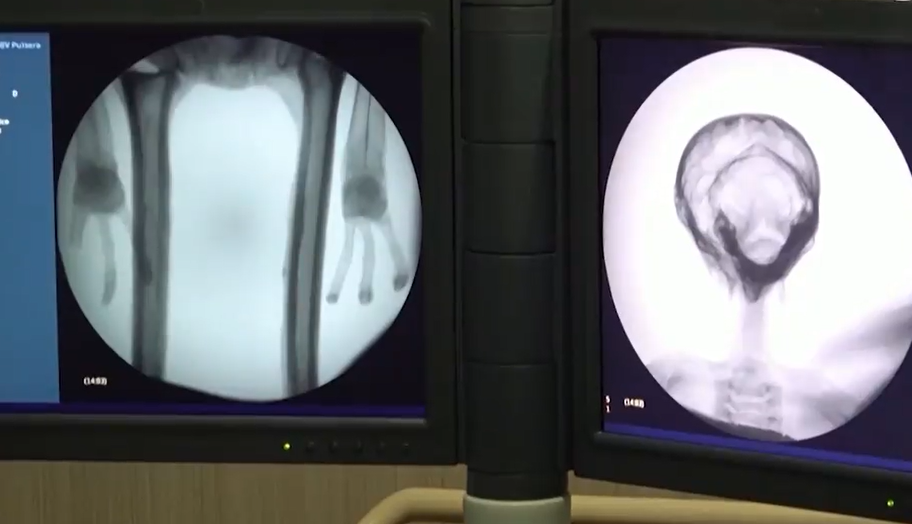 外星人遺骸|X光及電腦掃瞄結果指「外星人遺骸」未經人為接駁組裝。(互聯網)