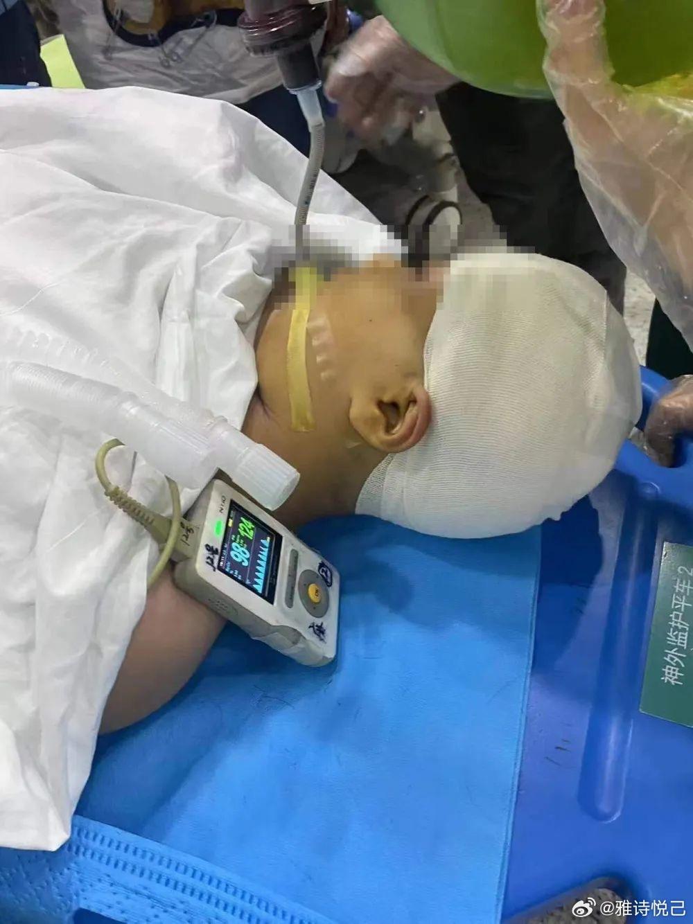 女童經過將近5個小時的手術後,碎裂的頭骨及異物順利從腦中取出。(微博)