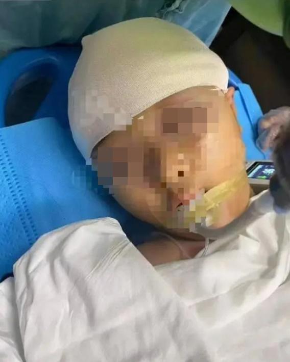 女童經過將近5個小時的手術後,碎裂的頭骨及異物順利從腦中取出。(微博)