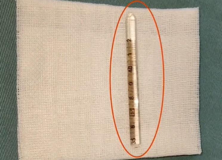 醫生將整支6.5厘米長的殘餘探熱針取出。(微博)