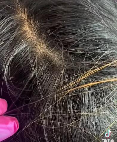 頭髮中有數之不盡的蝨和蟲卵,不少頭蝨還正在爬行。(TikTok)