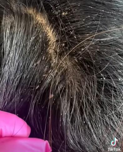 頭髮中有數之不盡的蝨和蟲卵,不少頭蝨還正在爬行。(TikTok)