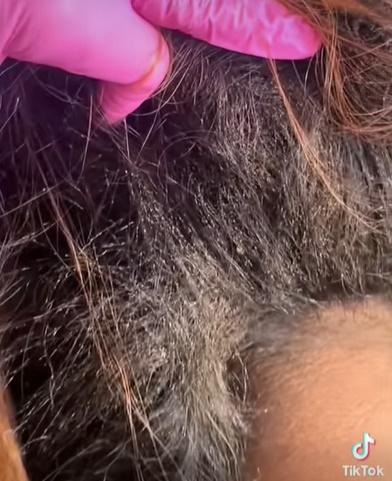 頭髮中有數之不盡的蝨和蟲卵,不少頭蝨還正在爬行。(TikTok)