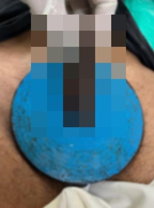 他忍受疼痛2小時,令陰莖幾乎呈現黑色,才找家屬陪伴前往醫院求醫。(Urology Case Reports)