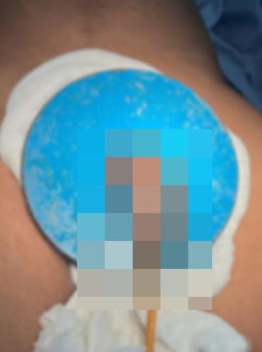 他忍受疼痛2小時,令陰莖幾乎呈現黑色,才找家屬陪伴前往醫院求醫。(Urology Case Reports)