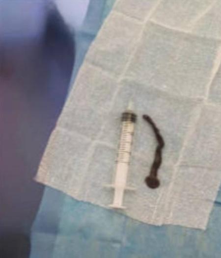 目測可見這條水蛭長達8厘米。(網上圖片)