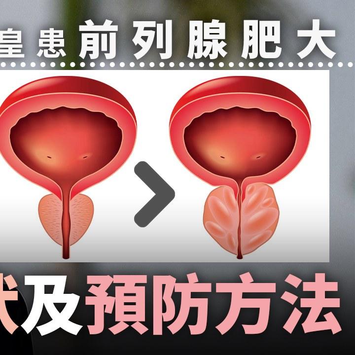 前列腺肥大原因、症狀及預防方法(am730製圖)