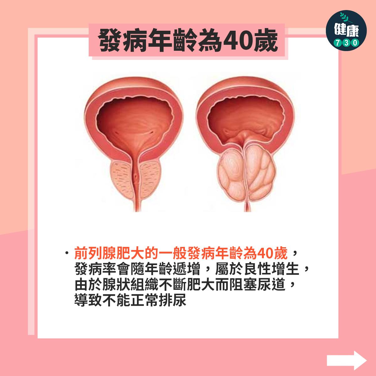 前列腺肥大原因、症狀及預防方法(am730製圖)