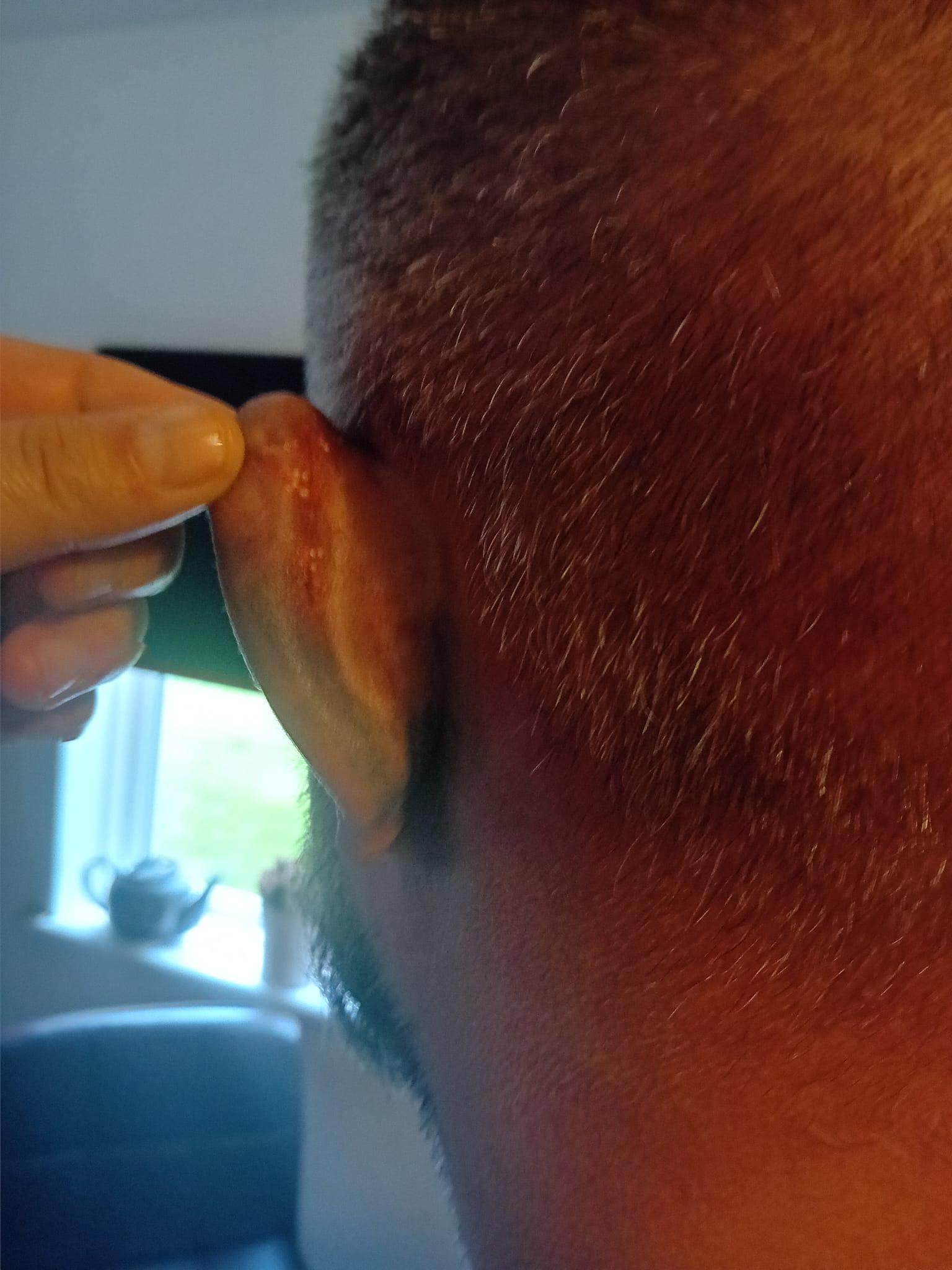 被狗咬傷|38歲英國男子Ben Cźyżyk耳朵受傷流血。(Ben Cźyżyk facebook)