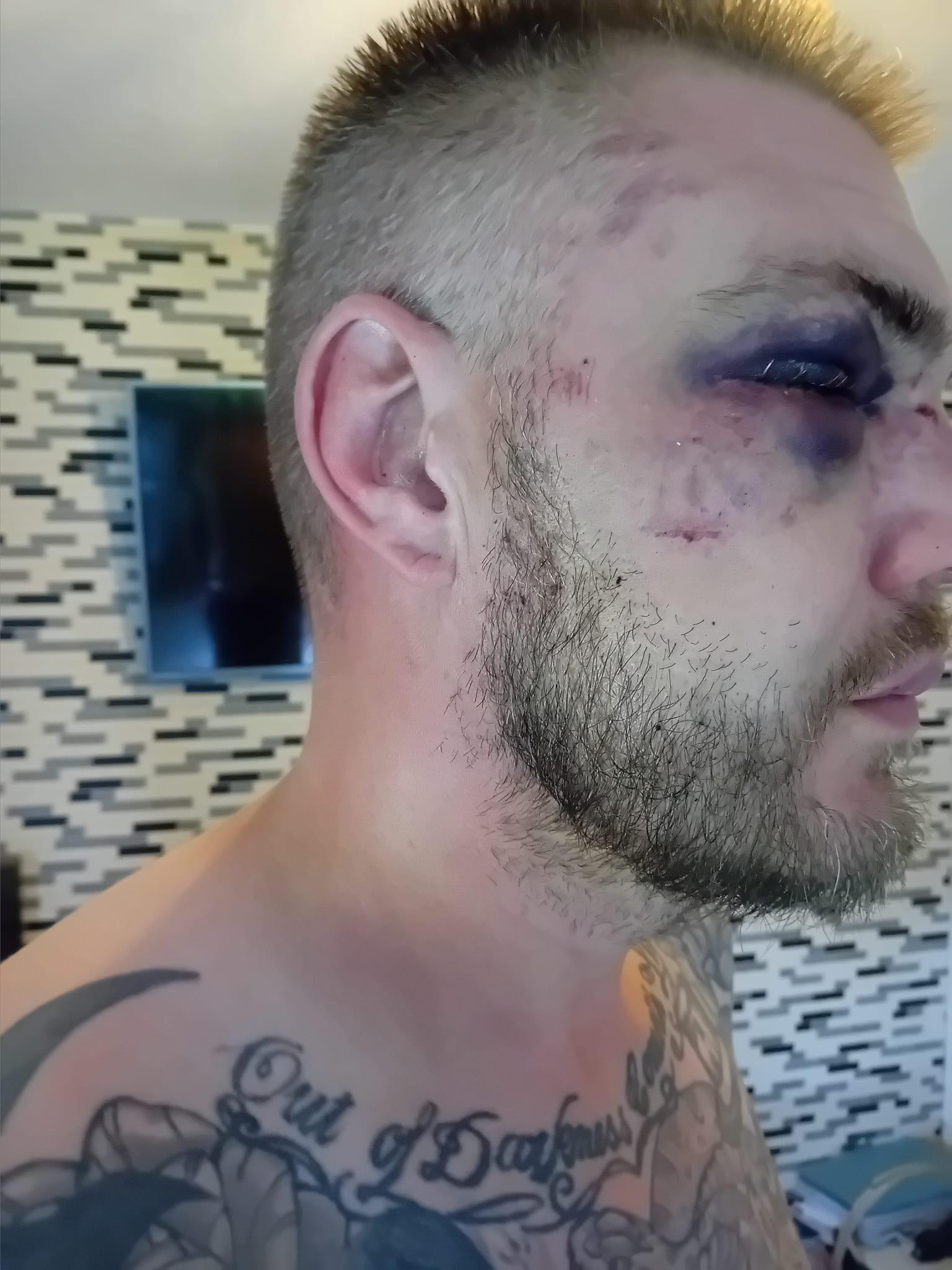 被狗咬傷|38歲英國男子Ben Cźyżyk眼窩12處骨折。(Ben Cźyżyk facebook)