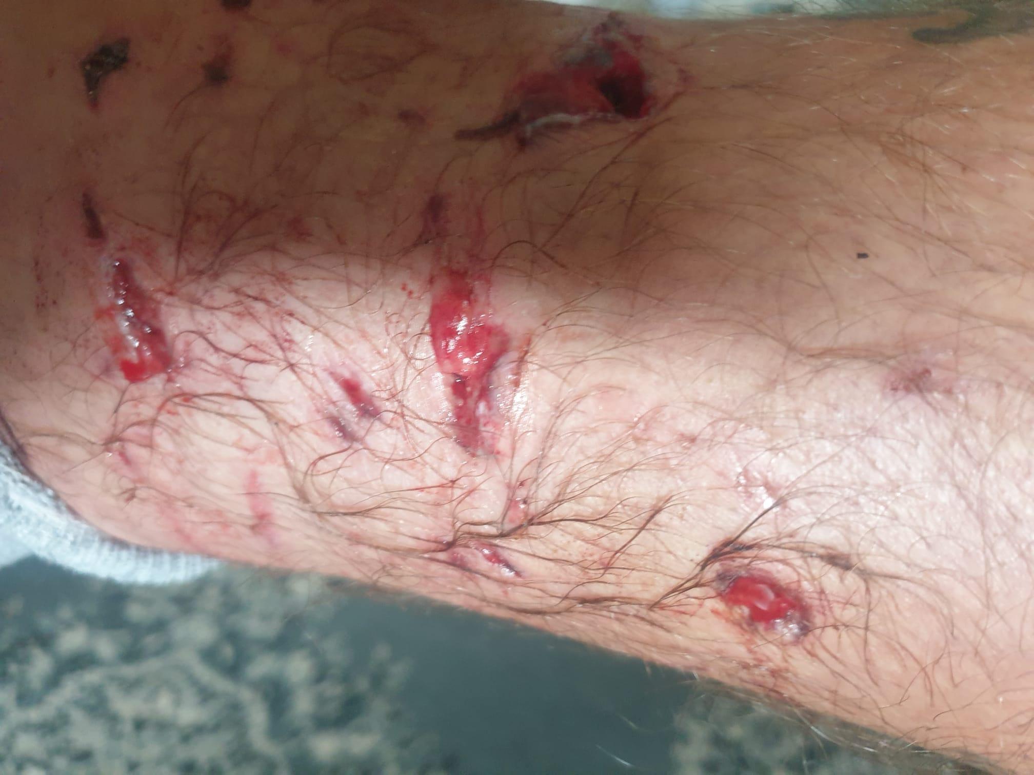 被狗咬傷|38歲英國男子Ben Cźyżyk周身傷。(Ben Cźyżyk facebook)