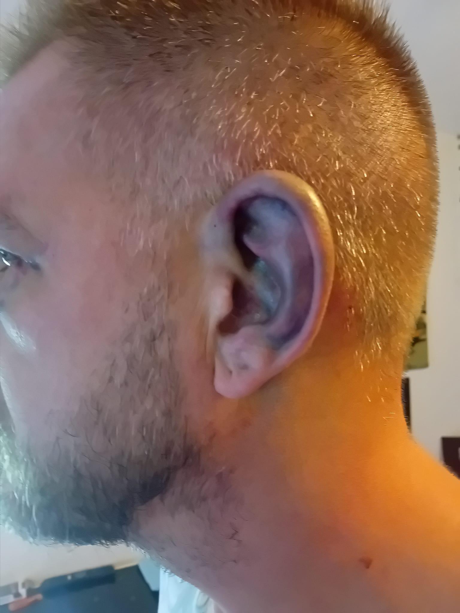 被狗咬傷|38歲英國男子Ben Cźyżyk眼窩12處骨折。(Ben Cźyżyk facebook)