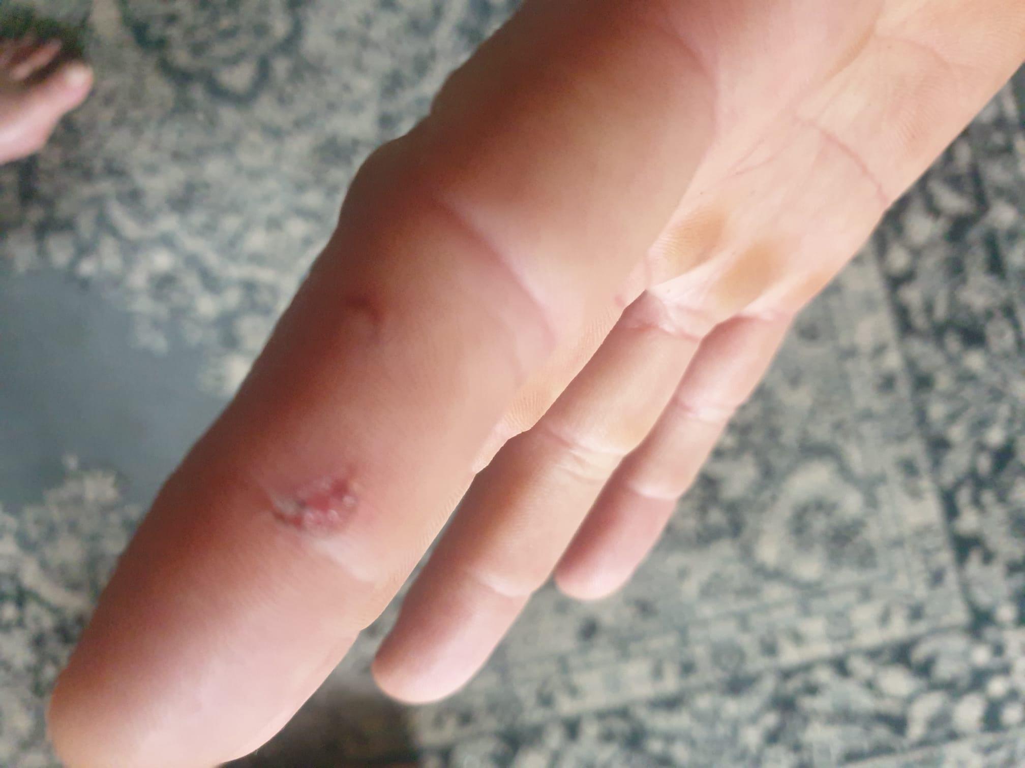 被狗咬傷|38歲英國男子Ben Cźyżyk手指也受傷。(Ben Cźyżyk facebook)